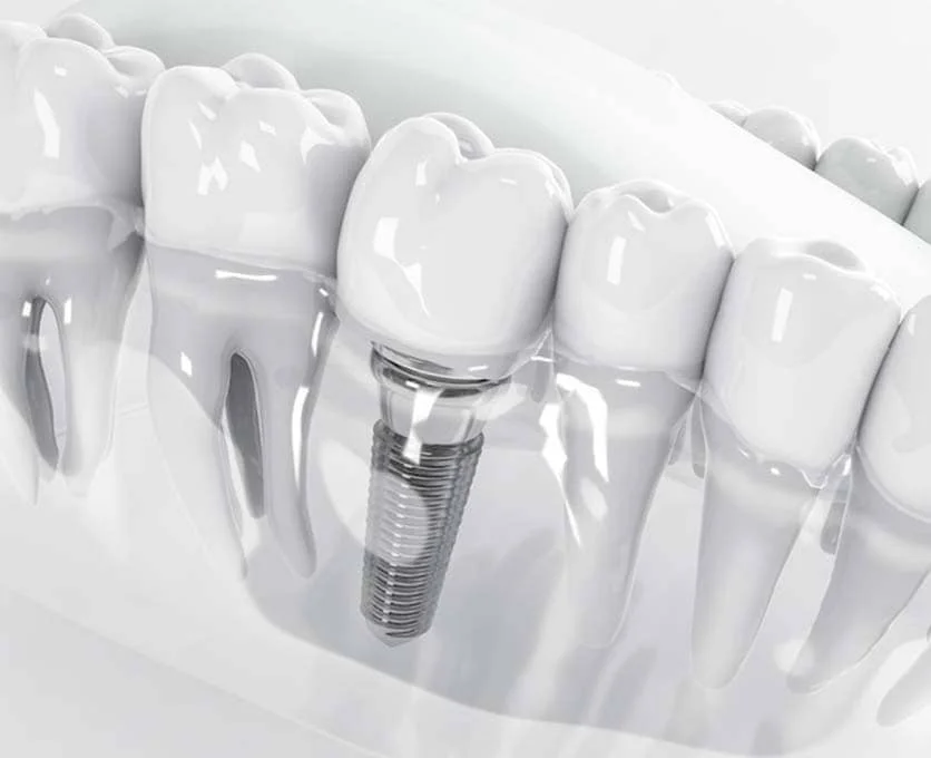 حرفه دندانسازی : انواع پروتز دندانی 